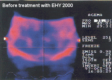 before treatment with EHY 2000