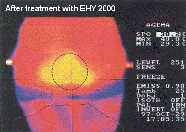 After treatment with EHY 2000